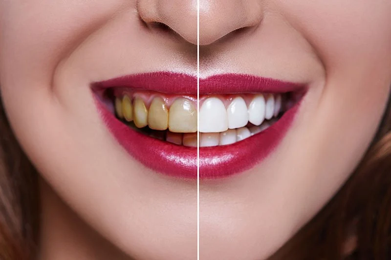 Quanto Costano Le Faccette Dentali