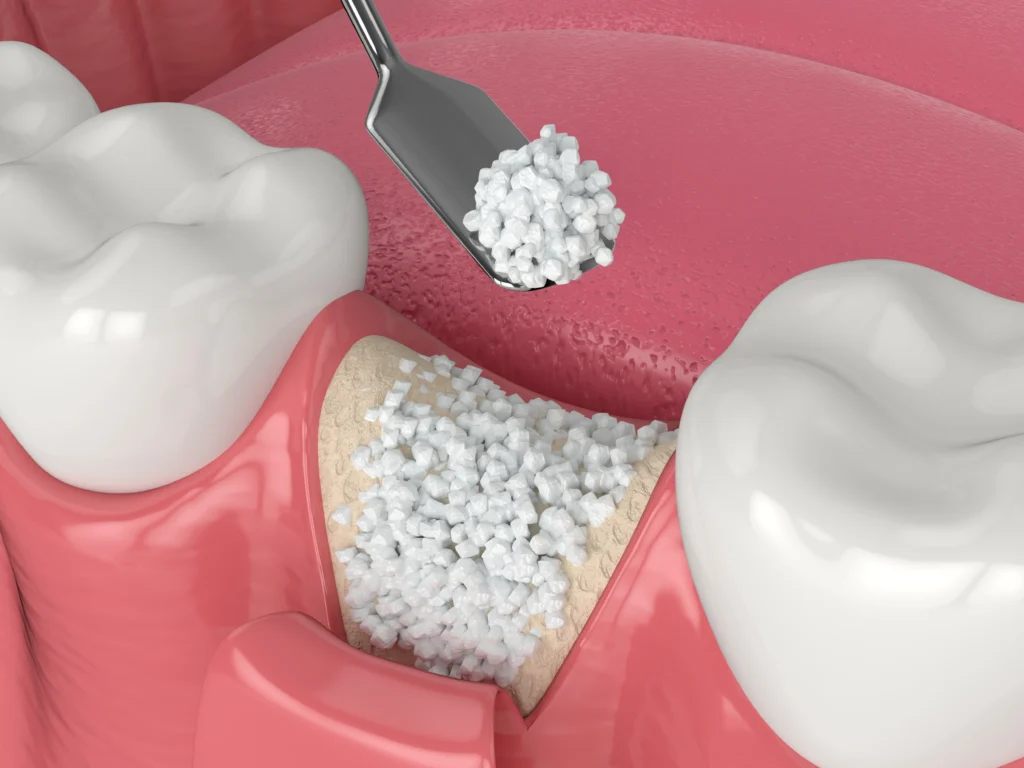 Quanto Dura Gonfiore Dopo Innesto Osseo Dentale