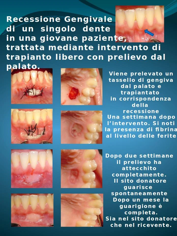 Tagli Alle Gengive