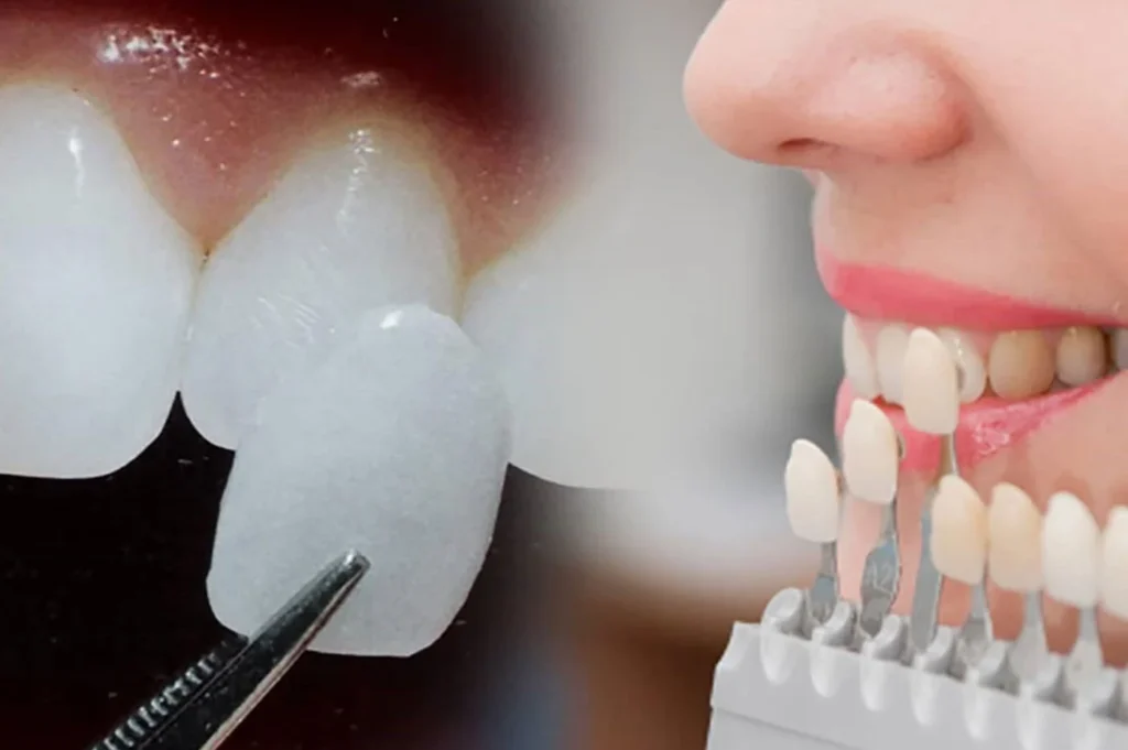 Veneering Denti
