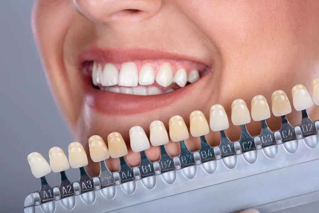 Veneering Denti