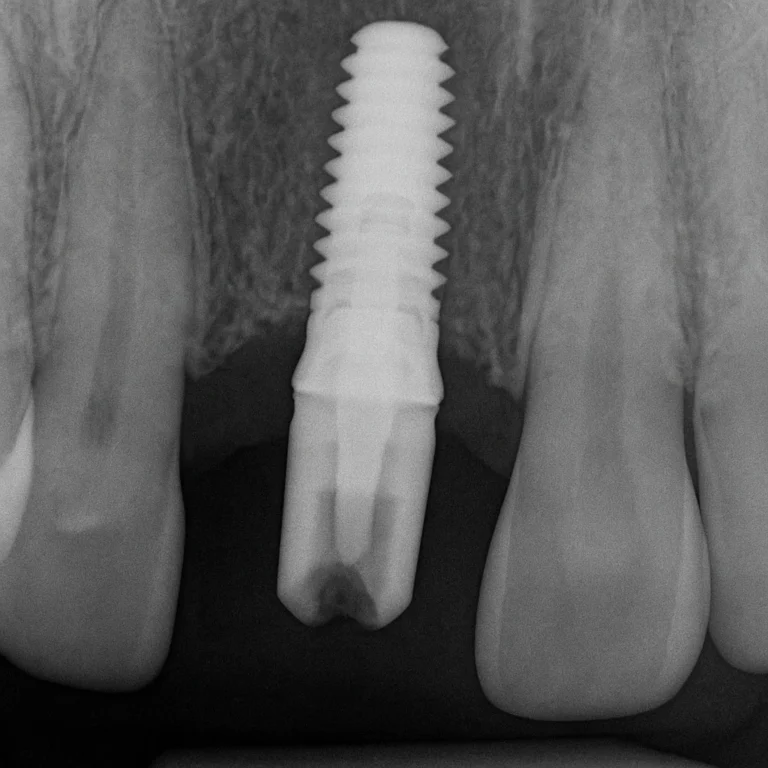 Innesto osseo non riuscito