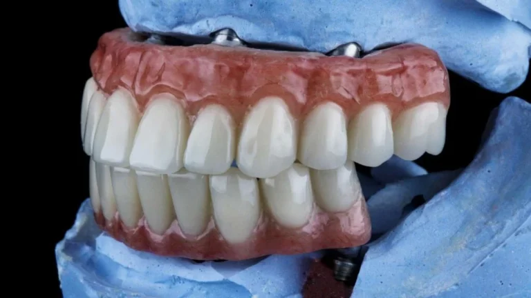 protesi dentali fisse