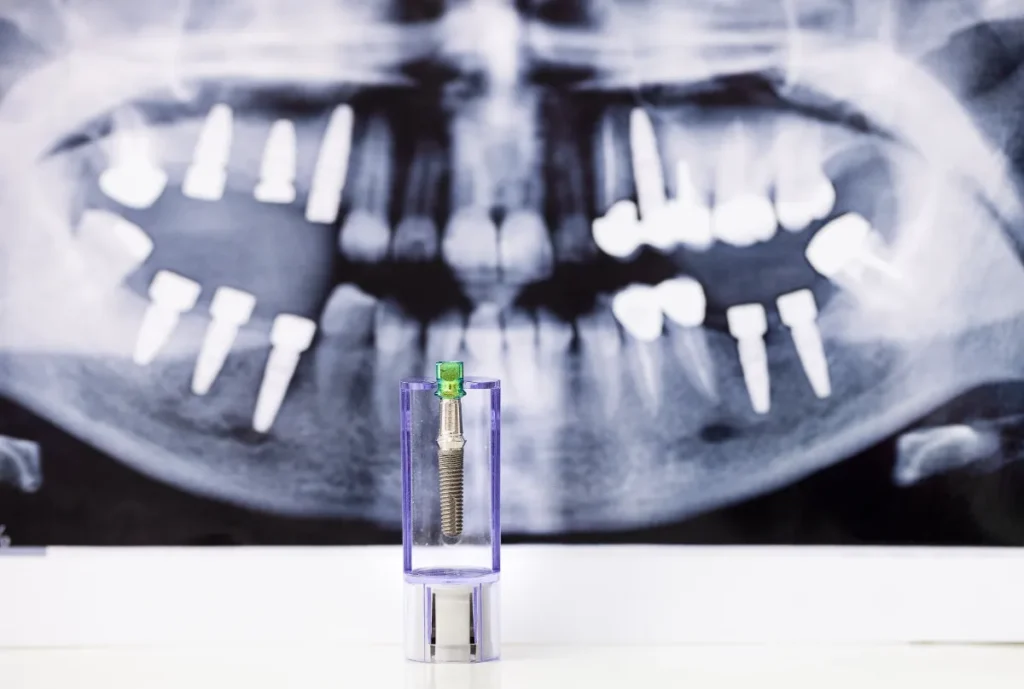 Implantes dentales All-on-6 en Albania