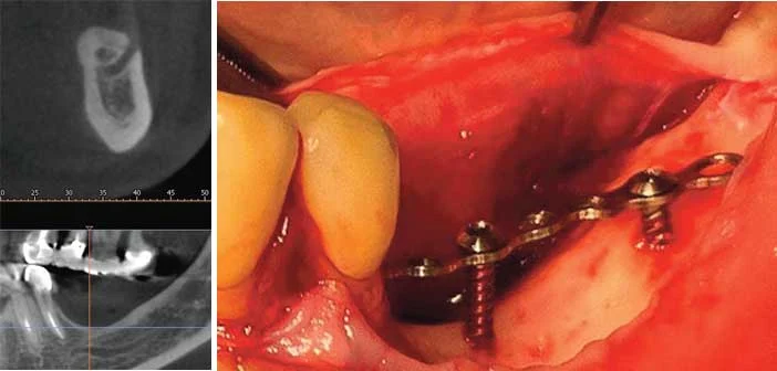 Augmentation osseuse