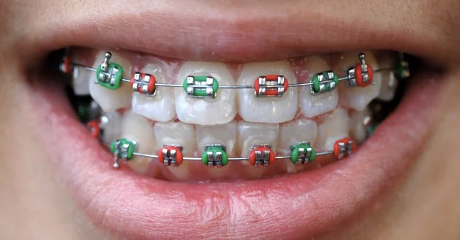orthodontie enfant