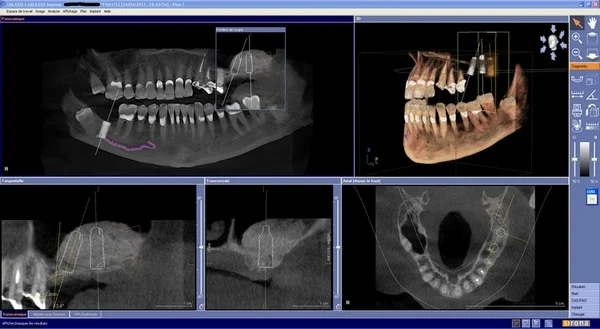 CBCT dentaire​