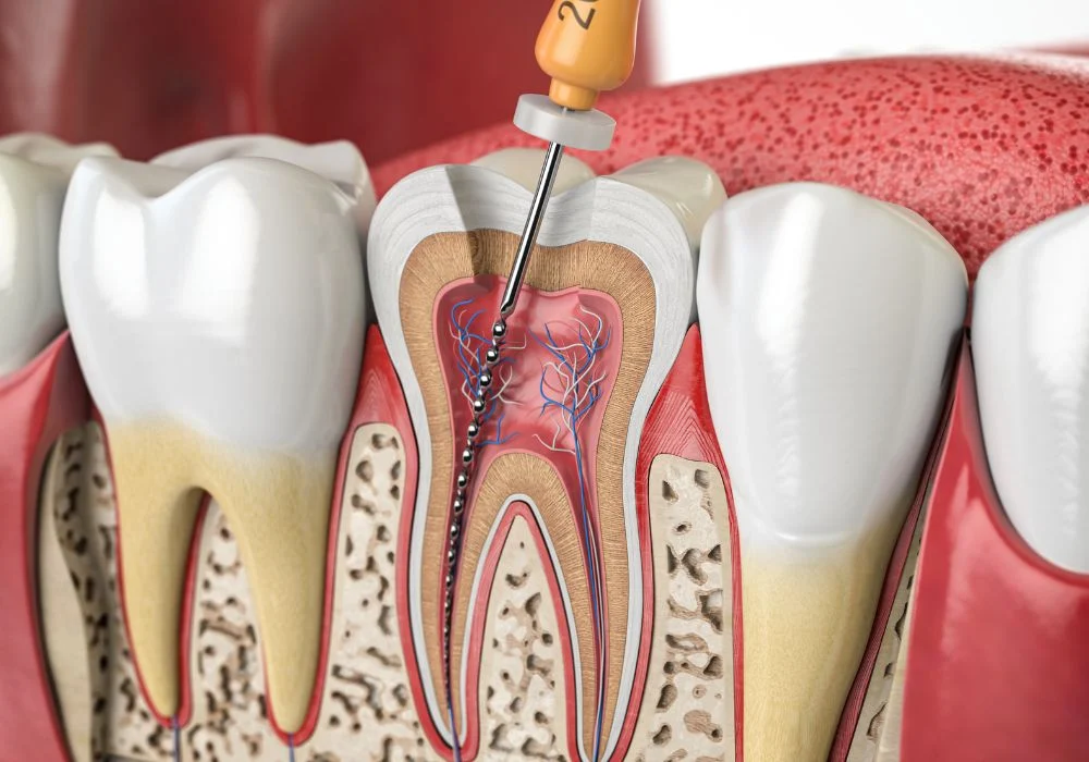 traitement endodontique