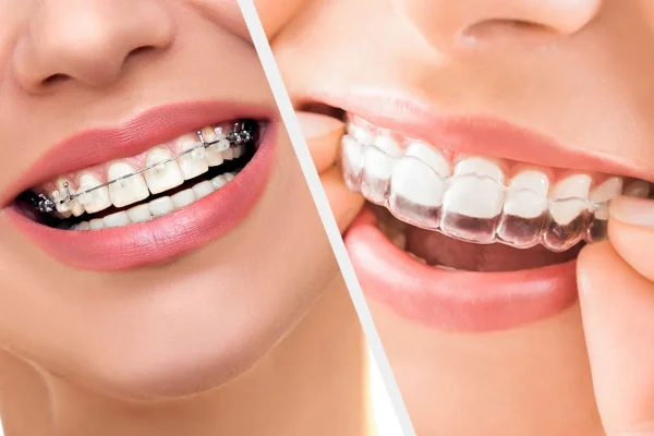 Aligners1