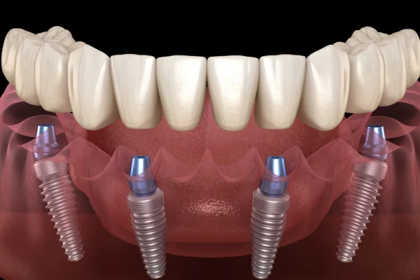 All on 4 dental implants