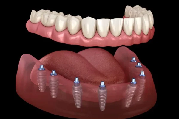 All on 8 dental implants​