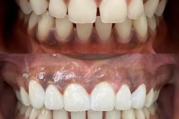 Bonding Teeth Cost
