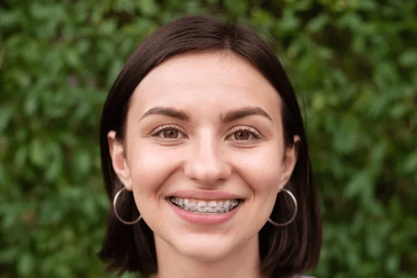 Braces On Adults
