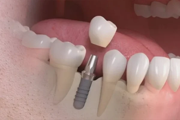 COSTI DI UN IMPIANTO DENTALE