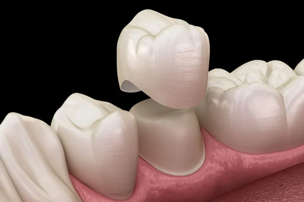 Capsula in Ceramica1
