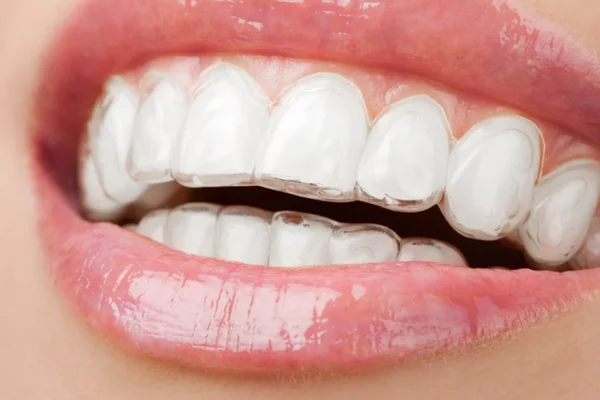 Contenzione Denti