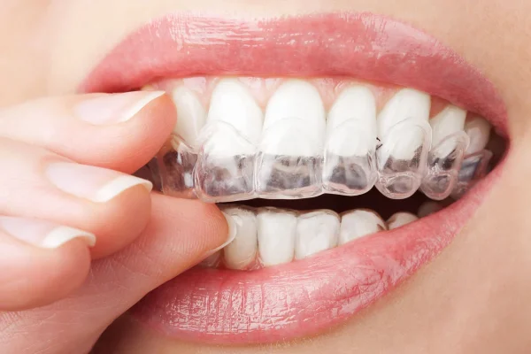 Contenzione denti