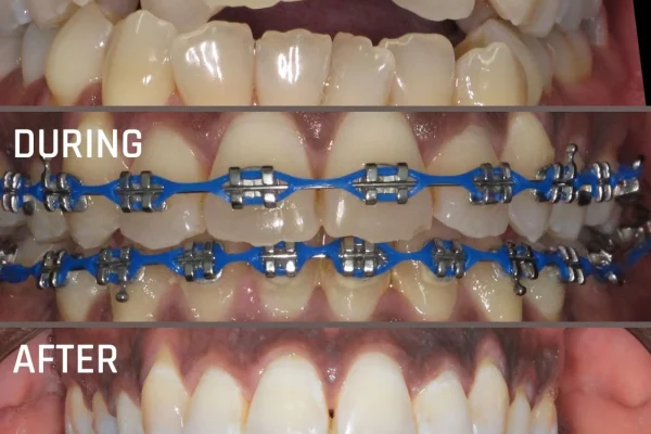 Cost Of Braces UK1