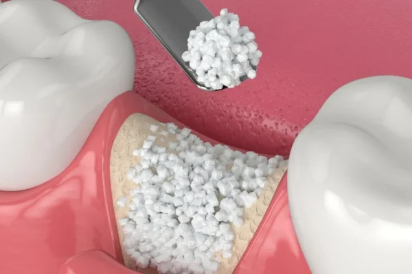 DENTAL BONE GRAFT SPECIALIST