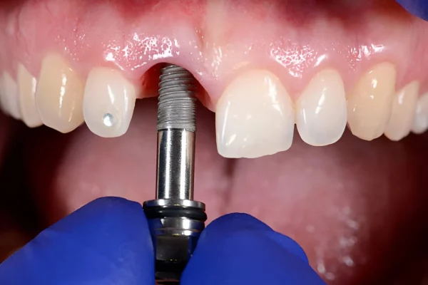 Dental Implants UK Cost