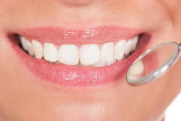 Denti Bianchi