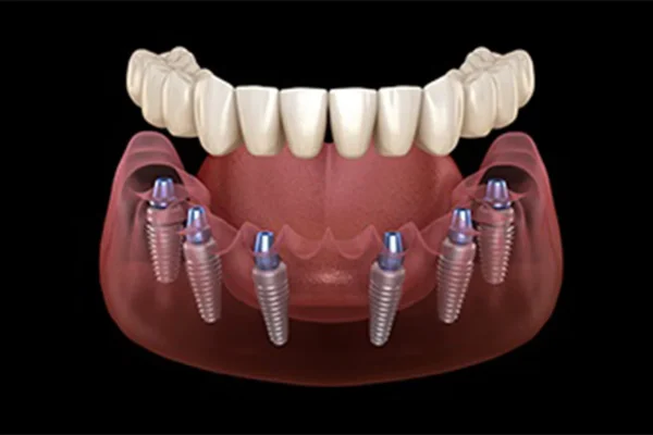 Denti Impianto Fisso