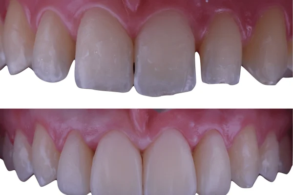 Denti Resina
