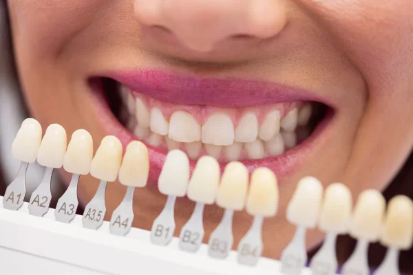 Denti Sbiancati2