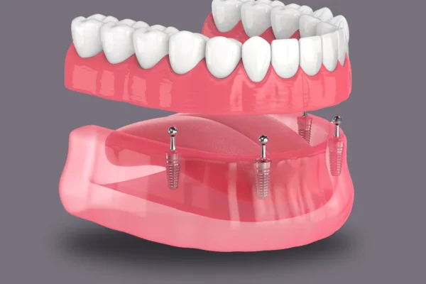 Dentures
