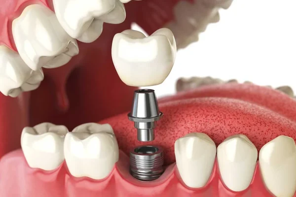 FALSE TOOTH