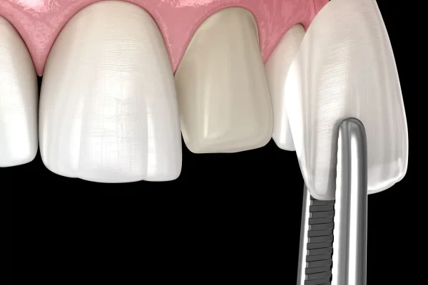 Faccette dentali