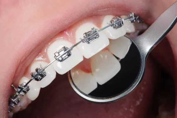 Fixed Braces