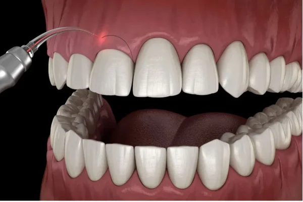 Gum Lift