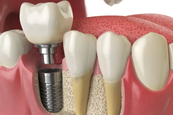 Impianti Dentali