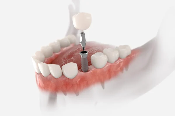 Impianto singolo dente