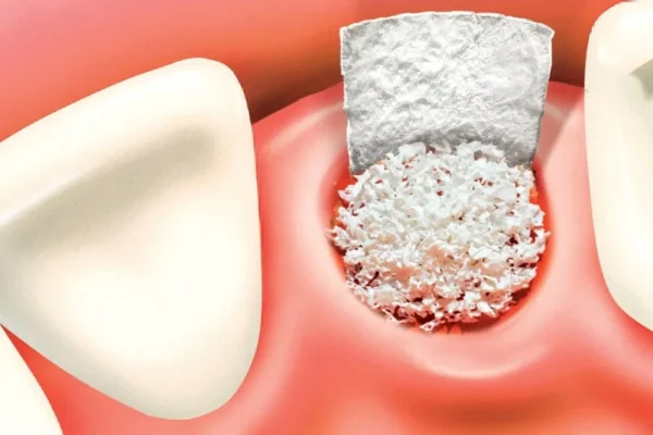 Innesto osseo per impianto dentale