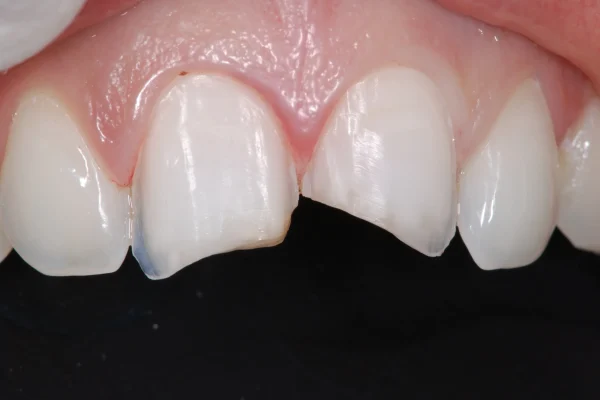 Limare i denti