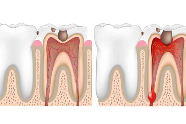 Losers Cavity