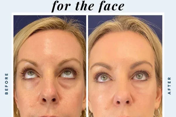 PRF Treatment