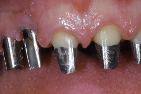 Perni Per Denti1
