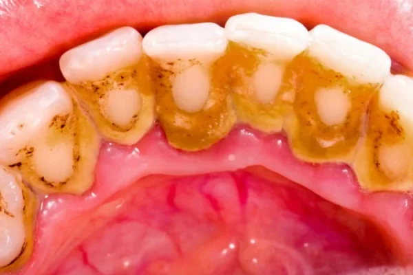 Placche Dentali1