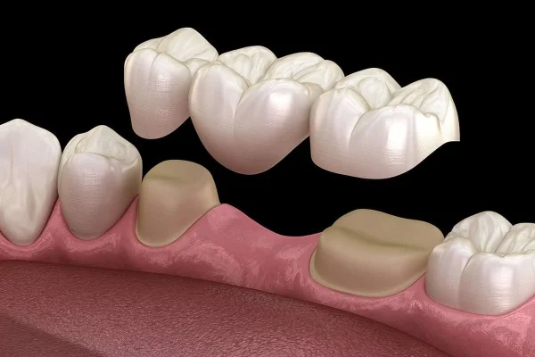 Ponte Per Denti2