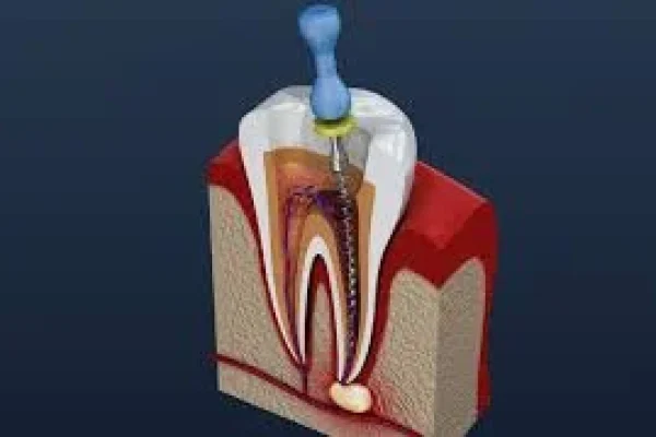 ROOT CANALS THERAPY