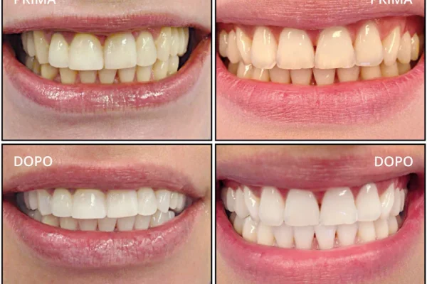 Sbiancante Denti...