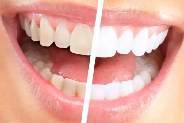Sbiancare I Denti