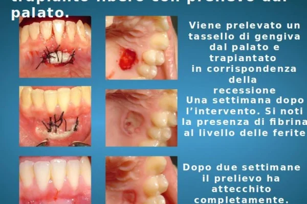Tagli Alle Gengive