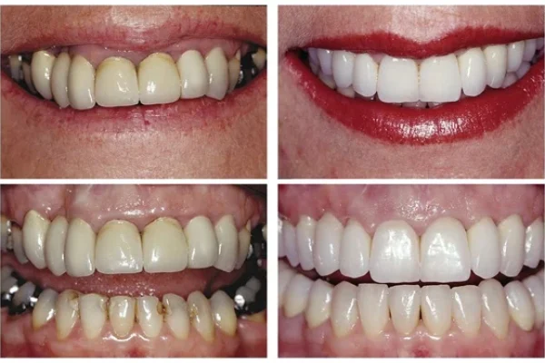 Teeth Caps