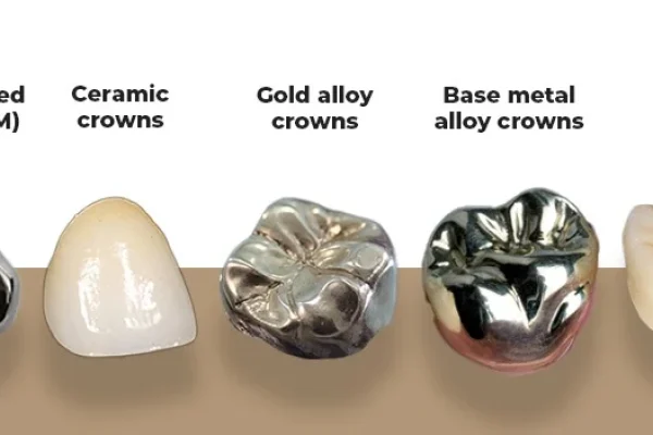 Types Of Crowns