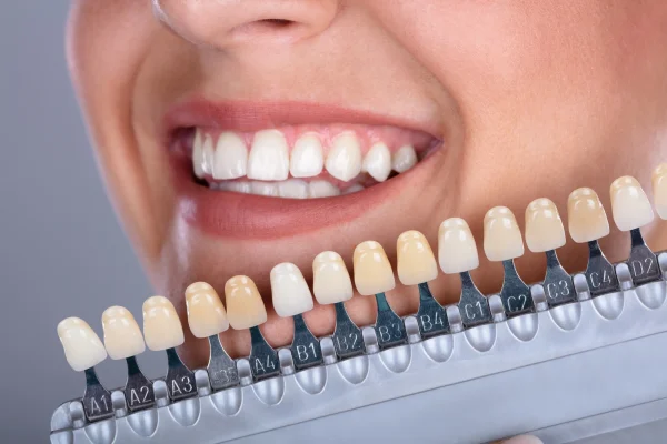 Veneering Denti
