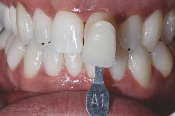 Veneers E-MAX4